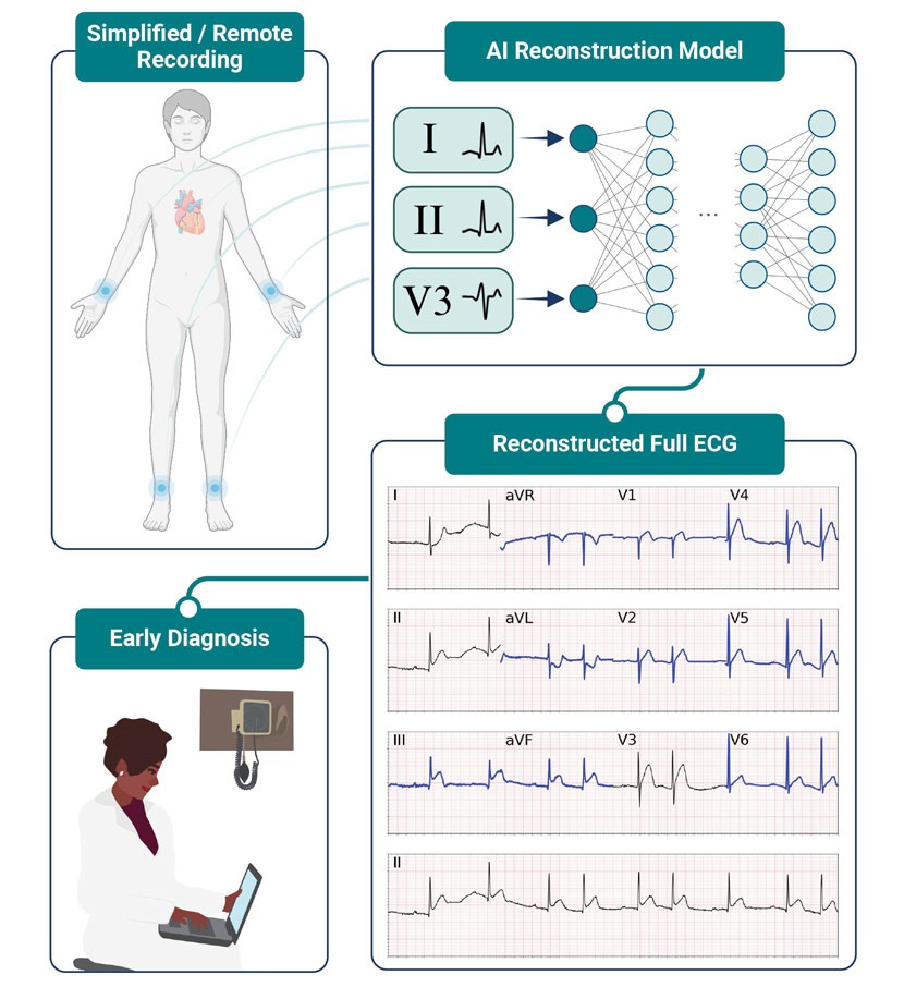 Imagen: Las enfermedades cardíacas se pueden diagnosticar con la misma precisión utilizando solo tres electrodos y una herramienta de IA (foto cortesía de la investigación de Scripps)