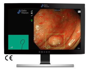 Imagen: La IA basada en la nube CADDIE para colonoscopia ayuda a los médicos a detectar y caracterizar pólipos durante los procedimientos de colonoscopia (foto cortesía de Odin Vision)