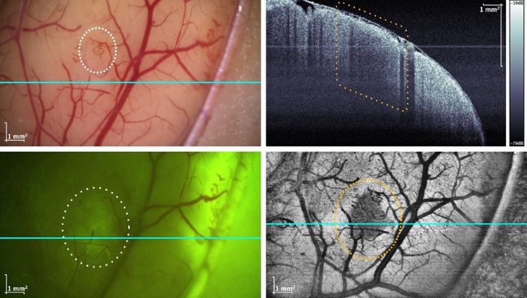 Imagen: Los investigadores han integrado su sistema MHz-OCT en un microscopio neuroquirúrgico (foto cortesía de la Universidad de Lübeck)