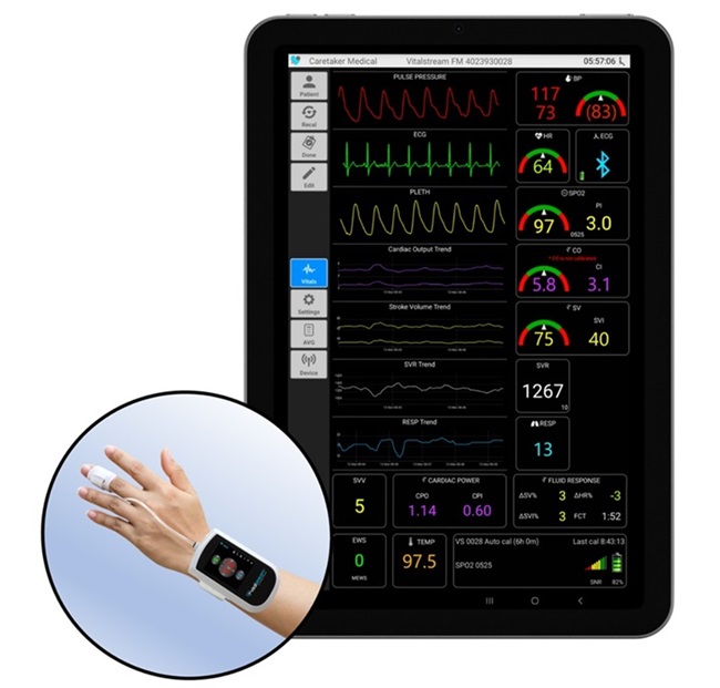 Imagen: VitalStream es el único monitor portátil inalámbrico de presión arterial y gasto cardíaco continuo del mundo aprobado por la FDA  (foto cortesía de de Caretaker Medical).