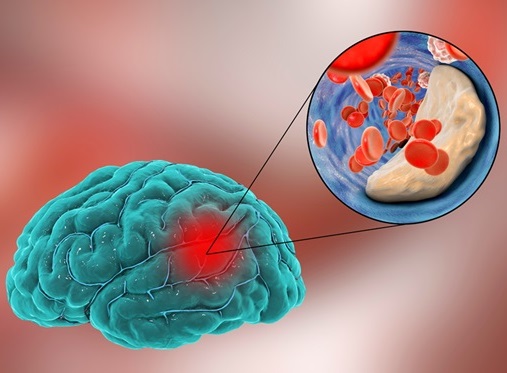 Imagen: El modelo de aprendizaje profundo predecirá los resultados clínicos en pacientes con accidente cerebrovascular tratados con medicamentos trombolíticos y/o terapia endovascular (foto cortesía de 123RF)