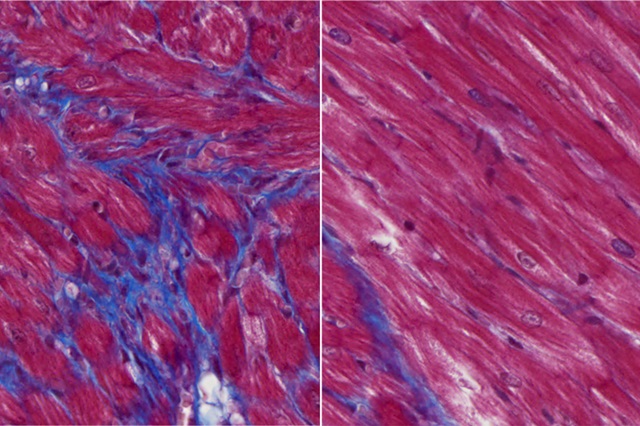 Imagen: Los ratones no tratados desarrollan cicatrices importantes después de una lesión cardíaca (tejido morado, izquierda), mientras que los animales tratados muestran cicatrices mucho menores (derecha)  (foto cortesía de WashU Medicine)