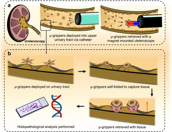 Imagen: Esquema conceptual que muestra las micropinzas (µ-pinzas) que funcionan como herramientas de biopsia en el tracto urinario superior (foto cortesía de Wangqu Liu, Yan Wan/Gracias Lab, Johns Hopkins University)