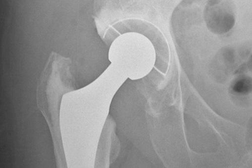 Imagen: El estudio comparó los resultados de los pacientes después del tratamiento con LBMT versus CDT para EP de riesgo intermedio (foto cortesía de la Unidad de Investigación Musculoesquelética, Universidad de Bristol)