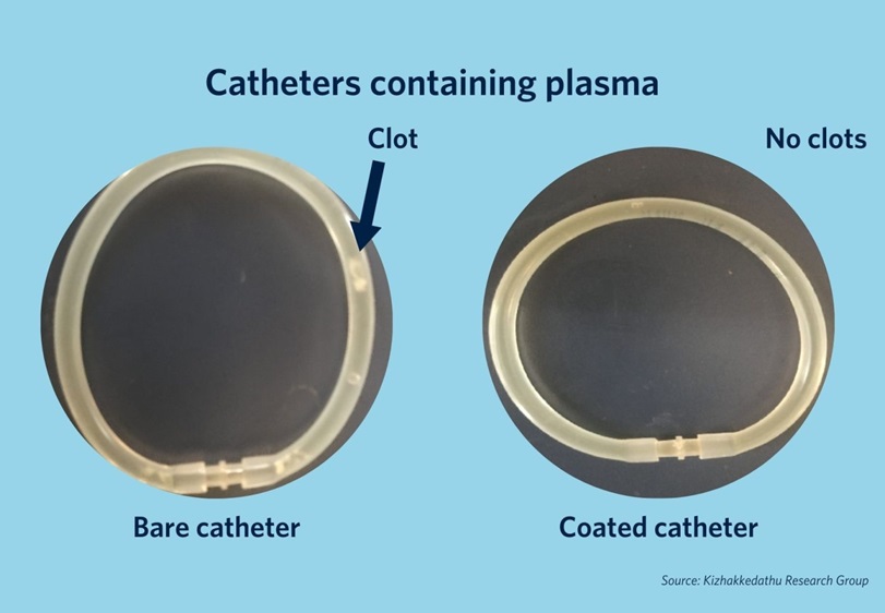 Imagen: Los catéteres recubiertos con el nuevo material mostraron una reducción significativa de la coagulación en la superficie del dispositivo. (foto cortesía de la facultad de UBC Faculty of Medicine)