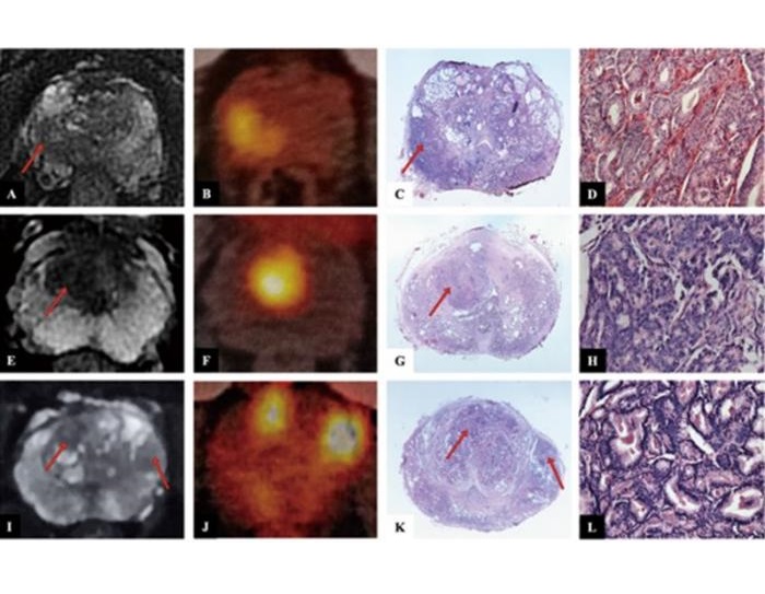 Imagen: Imágenes por RM antígeno de membrana específico de próstata, PET-CT, y tinción con hematoxilina y eosina de tres casos representativos (foto cortesía del profesor Nianzeng Xing. Doi: 10.1097/cm9.0000000000003204)