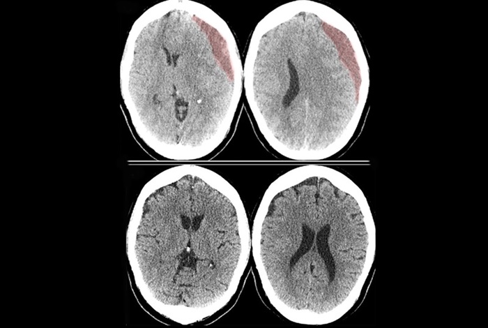 Imagen: La nueva combinación de tratamiento para el hematoma subdural reduce el riesgo de recurrencia (foto cortesía de la neurocirugía 85 (6): 801-807, diciembre de 2019)