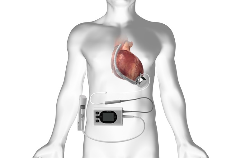 Imagen: El sistema BrioVAD con la innovadora bomba BrioVAD (foto cortesía de BrioHealth Solutions)