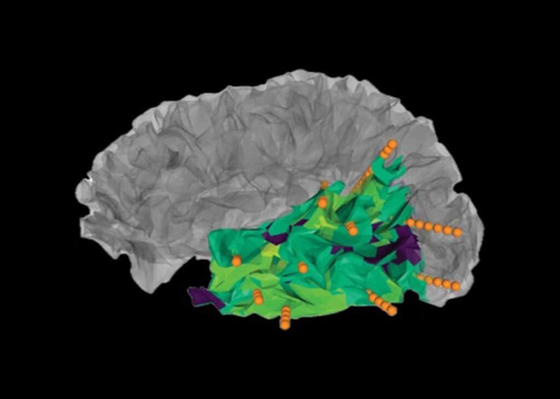 Imagen: La nueva herramienta permite a los neurocirujanos identificar con mayor precisión las áreas en el cerebro donde se originan las convulsiones (foto cortesía de Duke)