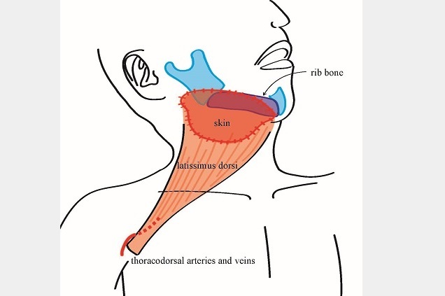 Imagen: Reconstrucción de la piel del cuello y la mandíbula mediante un colgajo LD pediculado (foto cortesía de OMU)