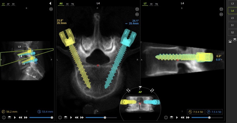 Imagen: Tanto la cirugía de columna asistida por robot como la de realidad aumentada permiten un alto grado de precisión y exactitud (foto cortesía de HSS)