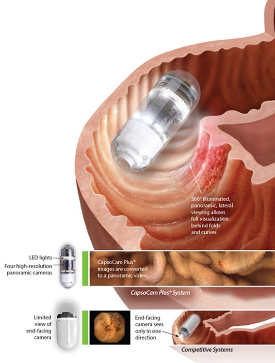 Imagen: El único sistema de endoscopia con cápsula con imágenes de 360° y sin equipos portátiles ya está disponible para pacientes pediátricos (Foto cortesía de CapsoVision)