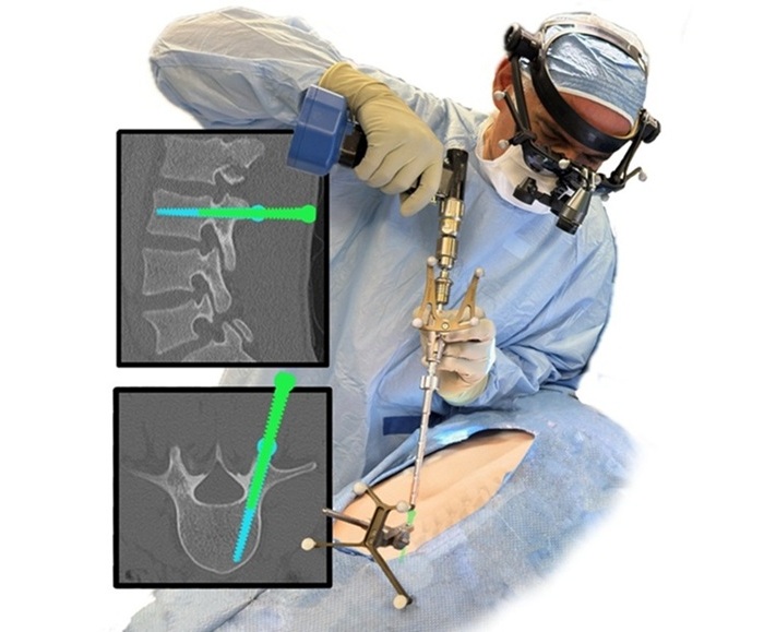 Imagen: OnPoint AR es un sistema avanzado de realidad aumentada diseñado para transformar la cirugía de columna (Foto cortesía de OnPoint Surgical)