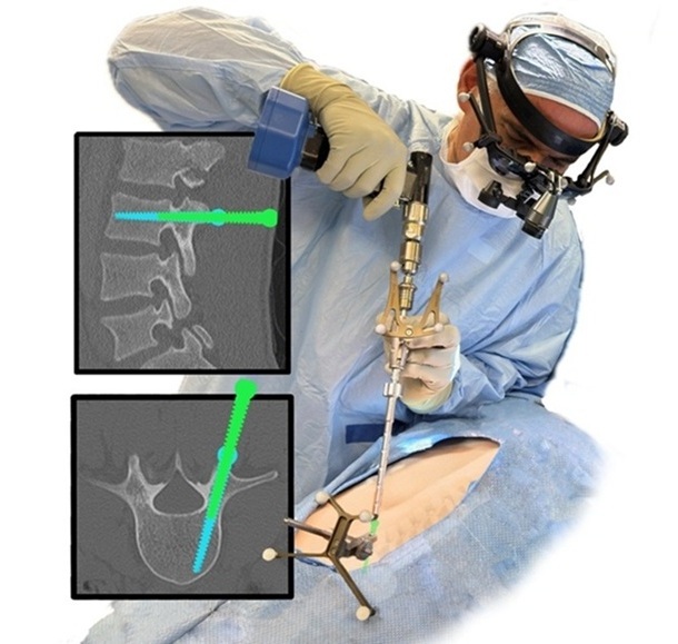 Imagen: OnPoint AR es un sistema avanzado de realidad aumentada diseñado para transformar la cirugía de columna (Foto cortesía de OnPoint Surgical)