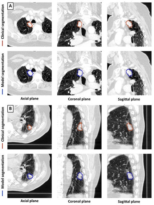 Imagen: Ejemplos de segmentación clínica y de modelos (Foto cortesía de Radiology, DOI:10.1148/radiol.233029) Imagen: Ejemplos de segmentación clínica y de modelos (Foto cortesía de Radiology, DOI:10.1148/radiol.233029)