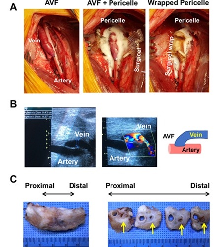 Imagen: Aplicación de Pericelle al modelo porcino de fístula arterio-venosa femoral (materiales bioactivos, doi: 10.1016/j.bioactmat.2024.10.005)