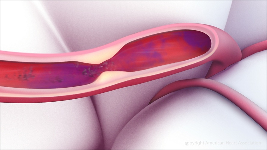 Imagen: El activador del plasminógeno tisular actúa disolviendo el coágulo cerebral y mejorando el flujo sanguíneo hacia la parte del cerebro afectada por la falta de irrigación (Foto cortesía de la American Heart Association)