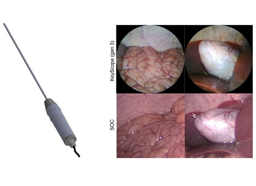 Imagen: El laparoscopio de bajo costo KeyScope permite obtener imágenes quirúrgicas de alta resolución (Foto cortesía de Barnes et al., doi 10.1117/1.BIOS.2.2.022302)