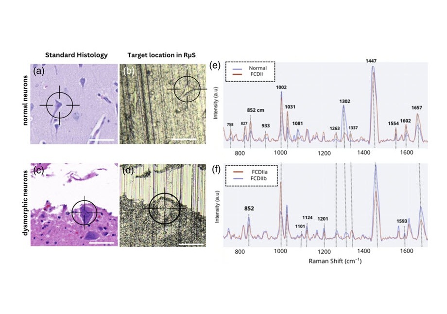 Imagen: la espectroscopía Raman distingue el tejido cerebral normal del tejido displásico en el análisis de una sola célula (foto cortesía de T. Tran et al., doi: 10.1117/1.BIOS.2.1.015002)