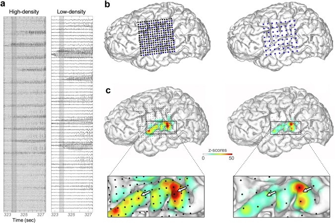 Imagen: el estudio demostró beneficios clínicos con respecto al uso de mayores densidades de conjuntos de electrodos en ICEEG para la cirugía de la epilepsia (foto cortesía de eBioMedicine, DOI: 10.1016/j.ebiom.2025.105606)