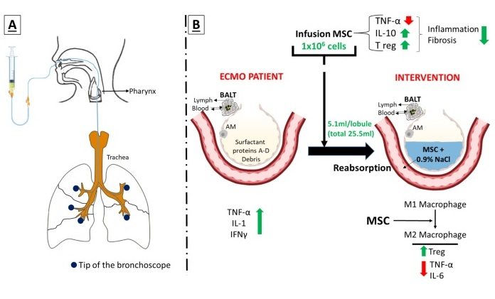 Imagen: las células estromales mesenquimales se introducen directamente en los pulmones mediante un broncoscopio (foto cortesía de Stem Cell Res Ther. 2025. DOI: 10.1186/S13287-025-04289-3)