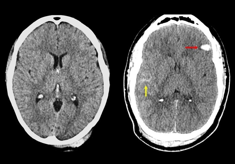Estas imágenes muestran cómo el nuevo marco de TBI impacta el tratamiento (foto cortesía de UCSF)