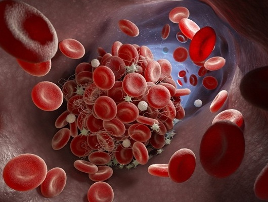 Imagen: un nomograma predice el riesgo de que las pacientes con cáncer de ovario epitelial desarrollen trombosis venosa profunda (foto cortesía de 123RF)