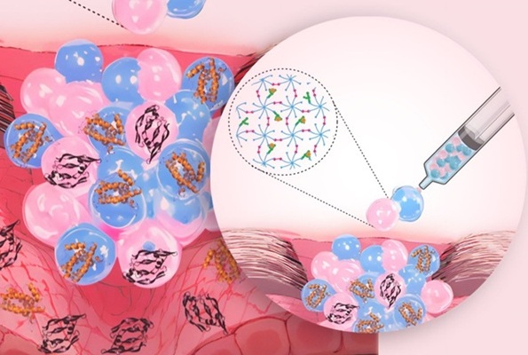 Imagen: el apósito inteligente para heridas consiste en un hidrogel granular (foto cortesía de Apoorv Singh/ETH Zurich)