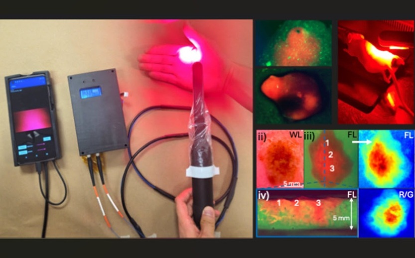 Imagen: la herramienta portátil utiliza imágenes de fluorescencia para identificar lesiones y administra una terapia de luz dirigida para destruir el tejido canceroso (Khan et al., DOI: 10.1117/1.Bios.2.4.042305)