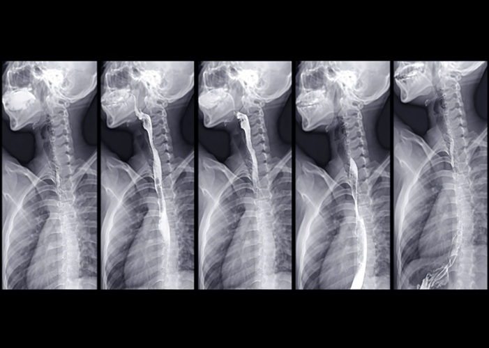 Imagen: un esofagram de bario cronometrado es una prueba de rayos X especializada utilizada para evaluar los trastornos motores esofágicos (foto cortesía de Adobe Stock)