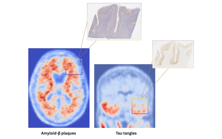 la imagen muestra exploraciones PET de amiloide y tau, y los depósitos de proteínas correspondientes (amiloide y tau) en cada una (Foto cortesía de Chobanian & Avedisian School of Medicine)