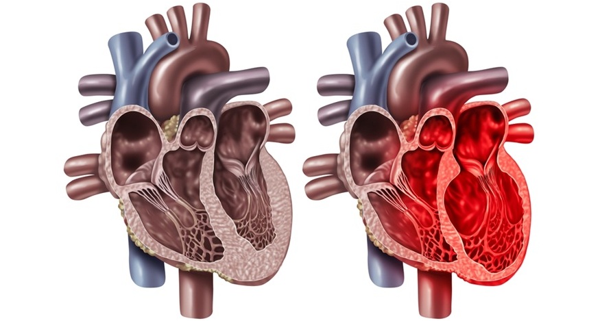 Imagen: la solución puede mejorar las vías clínicas de la UCI para pacientes con posible síndrome de Takotsubo (foto cortesía de Shutterstock)