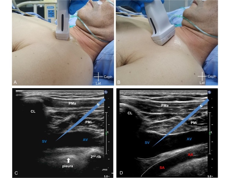 Imagen: diagrama esquemático de la aplicación del método SAVES (lado derecho) en comparación con el enfoque clásico (R Zhang et al., Journal of Intensive Medicine (2025). DOI: 10.1016/j.ultrasmedbio.2025.03.00489)