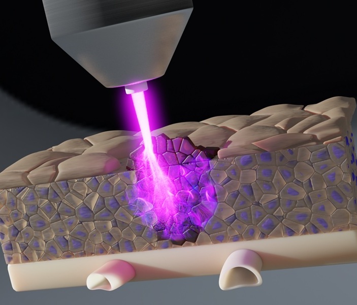 Imagen: el nuevo enfoque para combatir el cáncer utiliza plasma frío que penetra profundamente en el tejido (Fotografía cortesía del INP)