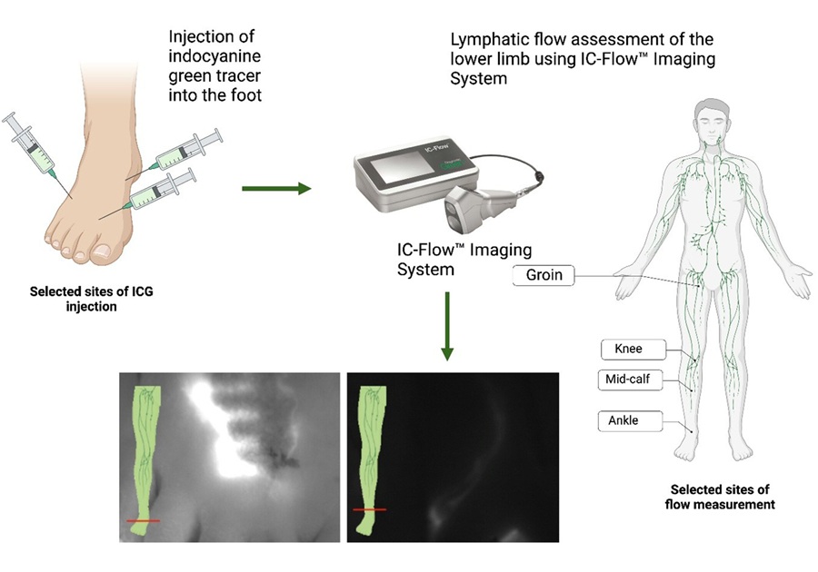 Imagen: Linfografía con verde de indocianina (ICG) en pacientes con insuficiencia cardíaca aguda (Ponikowska B. et al., Eur J Heart Fail (2025), DOI: 10.1002/ejhf.3655)