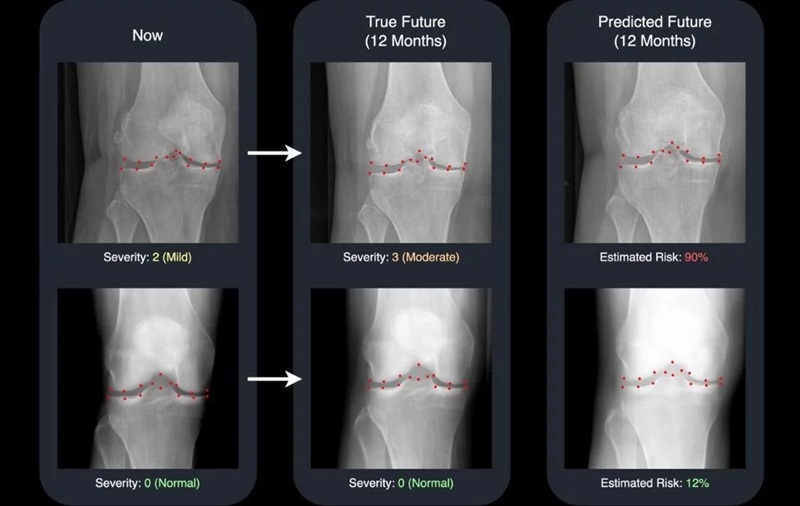 Imagen: La IA predice la progresión de la osteoartritis (Foto cortesía de la Universidad de Surrey) Imagen: La IA predice la progresión de la osteoartritis (Foto cortesía de la Universidad de Surrey)