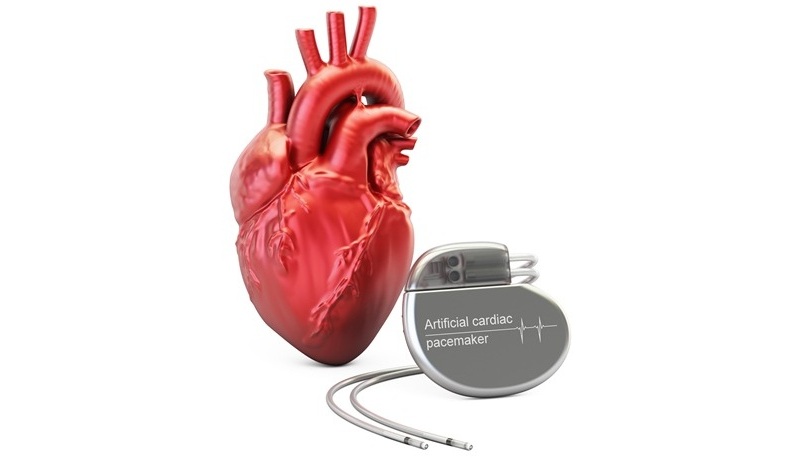 Imagen: la herramienta de modelado identifica qué funciones del marcapasos consumen más energía (Foto cortesía de 123RF)