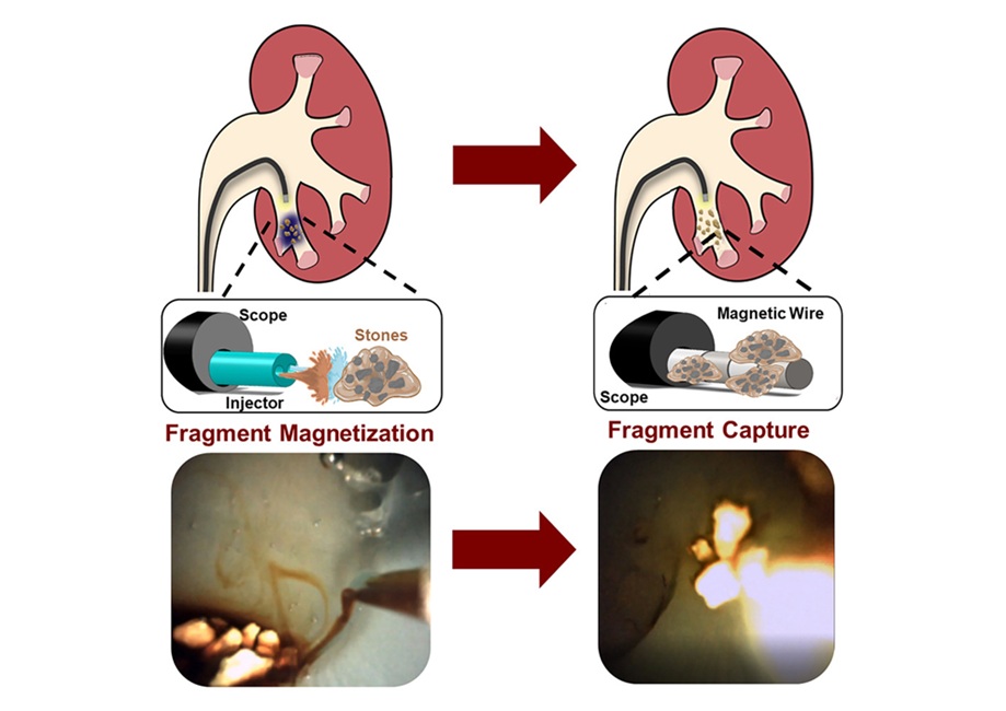 Imagen: el dispositivo médico mínimamente invasivo está diseñado para magnetizar y capturar fragmentos de cálculos renales (D M Roquero et al., Device (2025). DOI: 10.1016/j.device.2025.100971)