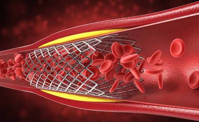 Imagen: Abrir todas las arterias coronarias bloqueadas puede mejorar significativamente la supervivencia a largo plazo después de un ataque cardíaco (Foto cortesía de Shutterstock)