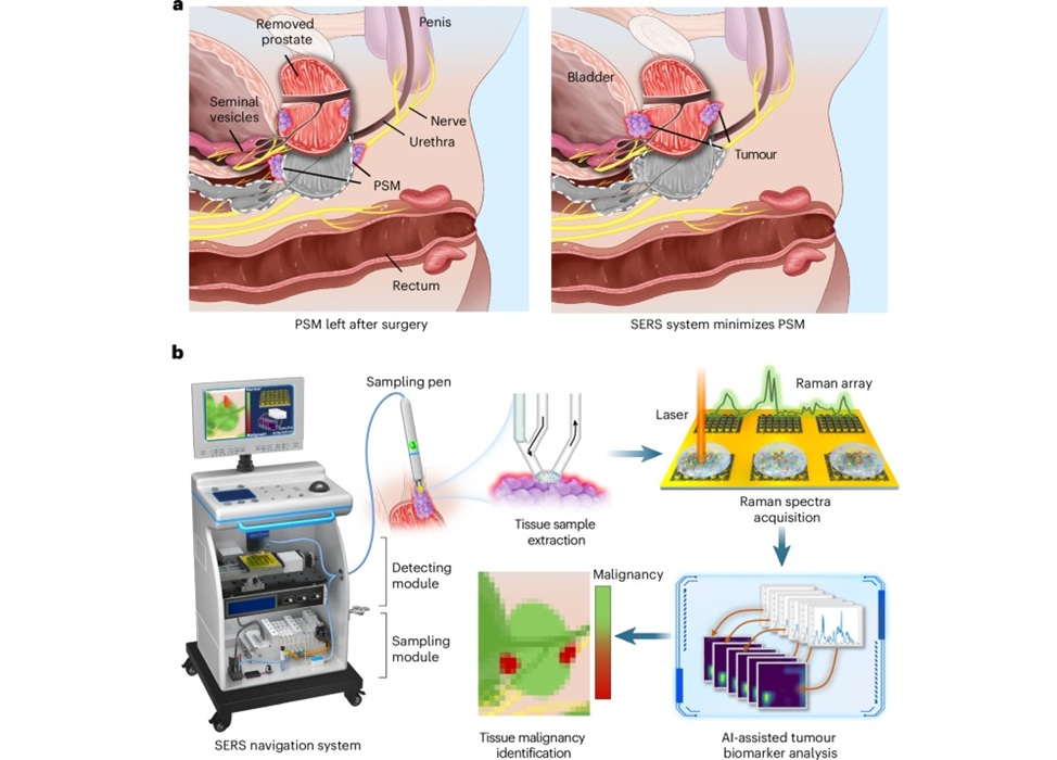 Imagen: un sistema de navegación SERS in situ para clasificar la malignidad de los tumores de próstata (Ziyi Jin et al., Nature Biomedical Engineering (2025). DOI: 10.1038/s41551-025-01561-y)