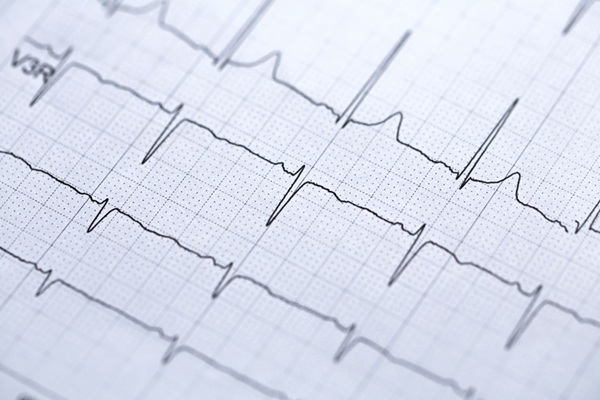 Imagen: La IA aplicada a ECG de rutina puede descubrir cambios sutiles en las señales cardíacas relacionados con la EPOC en etapa temprana (Adobe Stock)