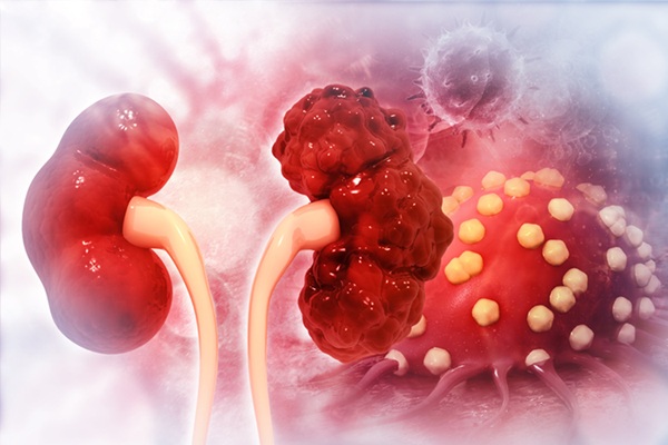 Imagen: los cambios sutiles en la función renal pueden revelar el riesgo de futuras enfermedades mucho antes de que aparezcan los síntomas (Fotografía cortesía de 123RF)