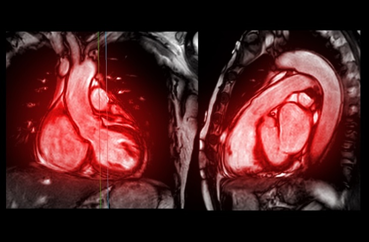 Imagen: Una resonancia magnética cardíaca estándar podría proporcionar mediciones críticas de oxígeno sin procedimientos invasivos con catéter (Fotografía cortesía de 123RF) Imagen: Una resonancia magnética cardíaca estándar podría proporcionar mediciones críticas de oxígeno sin procedimientos invasivos con catéter (Fotografía cortesía de 123RF)