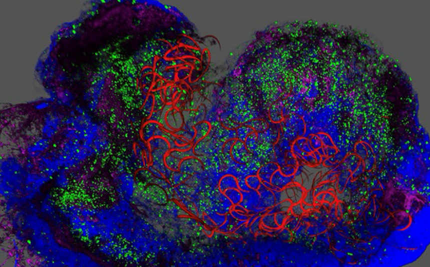 Imagen: los investigadores desarrollaron tejido pancreático (arriba) para que incorporara una red electrónica en forma de malla (rojo). Las células del tejido producen insulina (verde) (Foto cortesía de Penn Medicine)