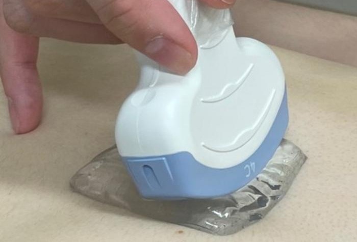 Imagen: La almohadilla de gel demostró una mayor satisfacción del paciente y una calidad de imagen comparable en comparación con el gel convencional (Fotografía cortesía de Hajime Monzen/Universidad Kindai) Imagen: La almohadilla de gel demostró una mayor satisfacción del paciente y una calidad de imagen comparable en comparación con el gel convencional (Fotografía cortesía de Hajime Monzen/Universidad Kindai)