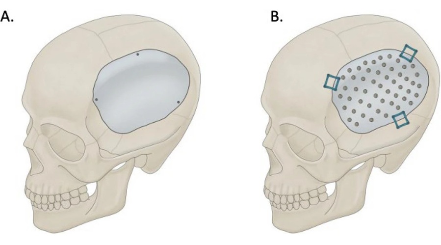 Imagen: Subtipos de craneoplastia PEEK que muestran un modelo liso (A) y un modelo perforado (B) (Zavala, C.A., Zima, L., Srinivasan, S. et al. Chin Neurosurg Jl 11, 31 (2025). doi.org/10.1186/s41016-025-00417-3)