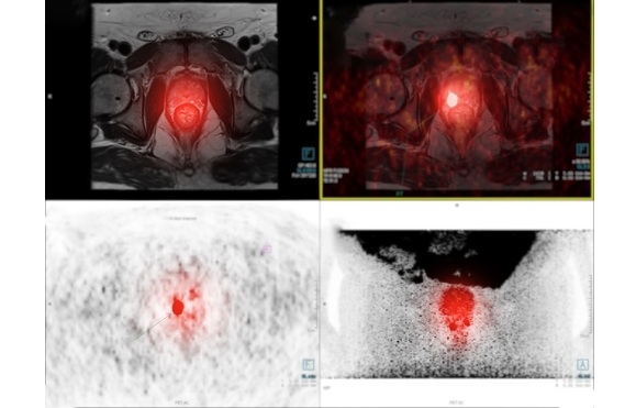 Imagen: TULSA es una terapia mínimamente invasiva que utiliza resonancia magnética en tiempo real para guiar la administración de ultrasonido dirigido a la próstata (fotografía cortesía de Shutterstock)