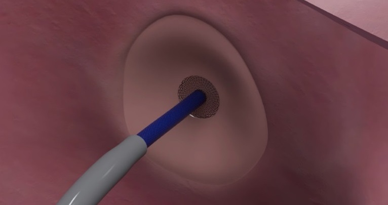 Imagen: el dispositivo de punción transeptal de Protaryx Medical es una solución de próxima generación diseñada para facilitar un acceso seguro, eficiente y reproducible a la aurícula izquierda, con el fin de respaldar las terapias contemporáneas (fotografía cortesía de Protaryx Medical)