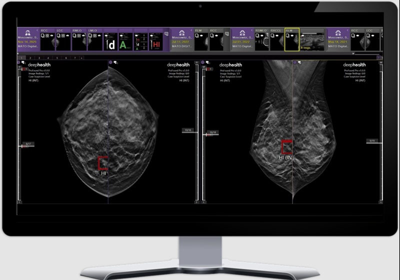Imagen: Breast Suite es un conjunto de aplicaciones interoperables modulares basado en la nube que se integra en los flujos de trabajo de imágenes de mama existentes (fotografía cortesía de DeepHealth)