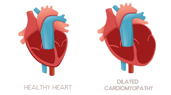 Imagen: La miocardiopatía dilatada, un agrandamiento del músculo cardíaco que debilita la función sistólica, deja a los niños críticamente enfermos con pocas terapias efectivas (fotografía cortesía de Adobe Stock)